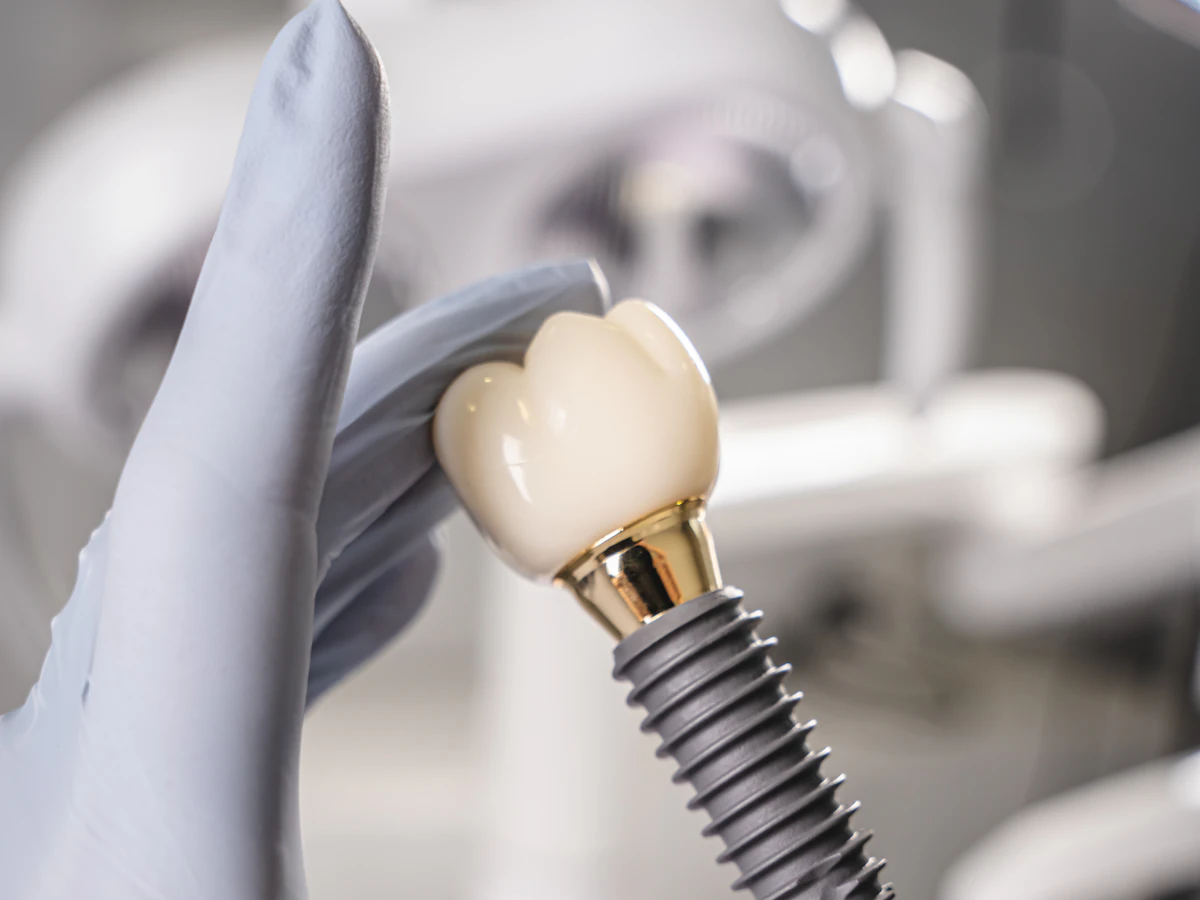 Implante dental con su corona, en la mano de un odontólogo