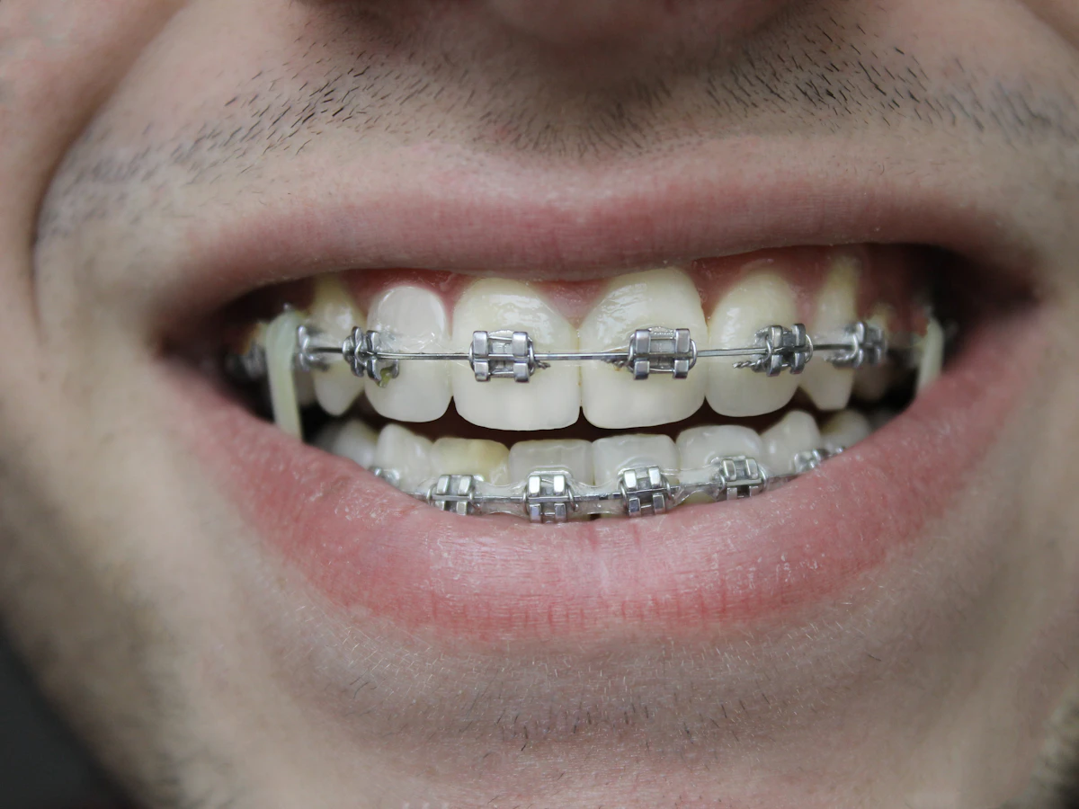 Sonrisa con brackets de ortodoncia
