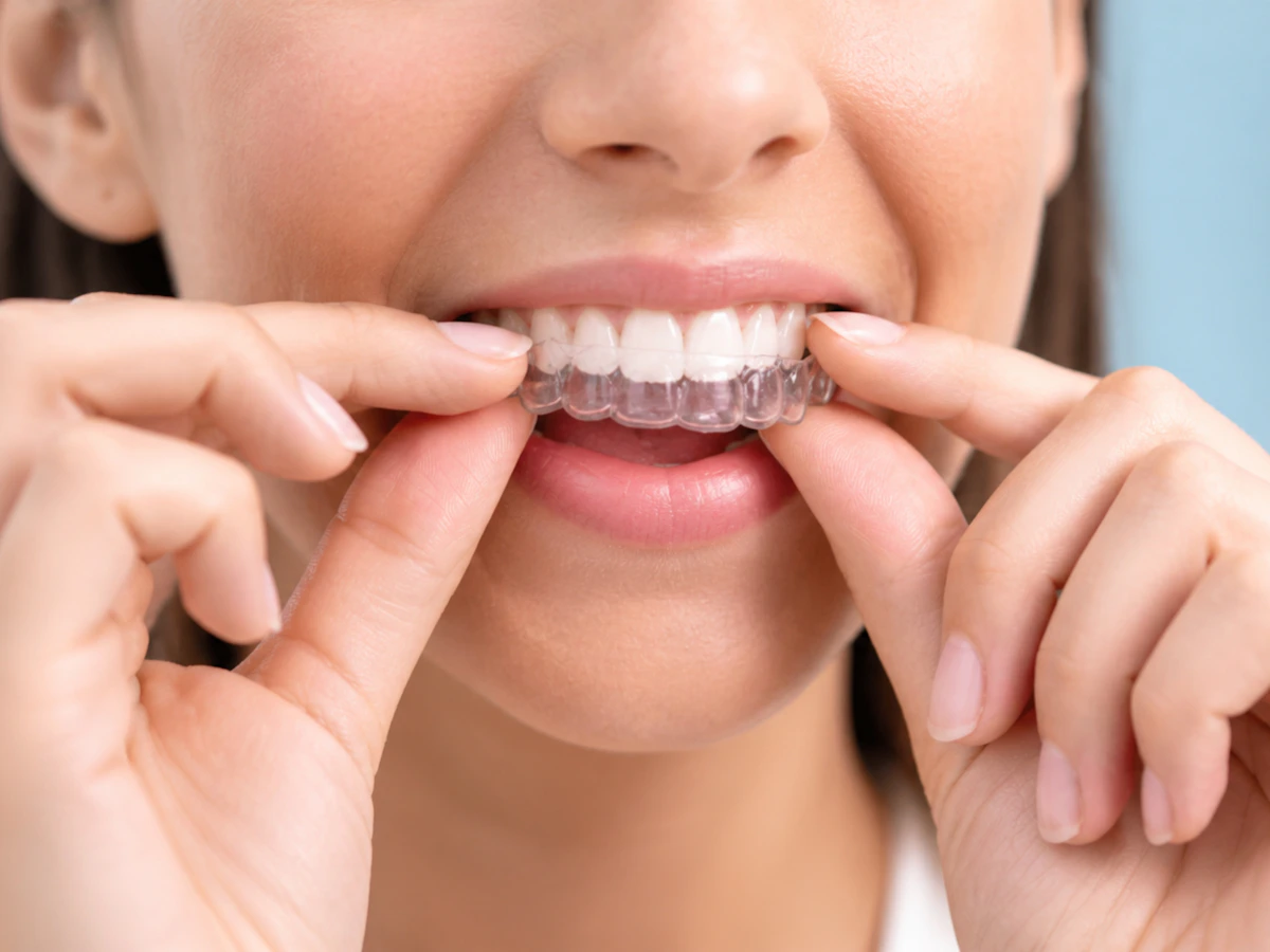 Alineador dental transparente en la mano